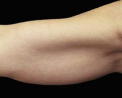 CoolSculpting before at Suddenly Slimmer Med Spa in Phoenix, AZ