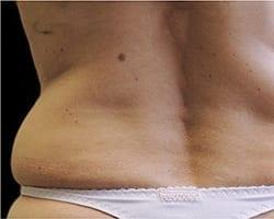 CoolSculpting before at Suddenly Slimmer Med Spa in Phoenix, AZ