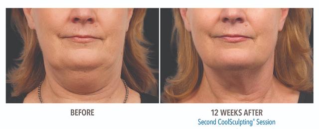 Thigh Lift result at Suddenly Slimmer Med Spa in Phoenix, AZ