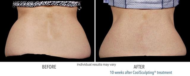 CoolSculpting result at Suddenly Slimmer Med Spa in Phoenix, AZ