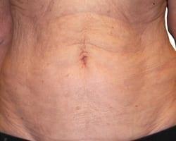 Suddenly Slimmer Med Spa after — Phoenix, AZ