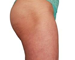 Suddenly Slimmer Med Spa bbl after — Phoenix, AZ