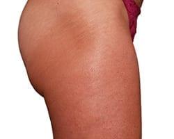 Brazilian Butt Lift before at Suddenly Slimmer Med Spa in Phoenix, AZ