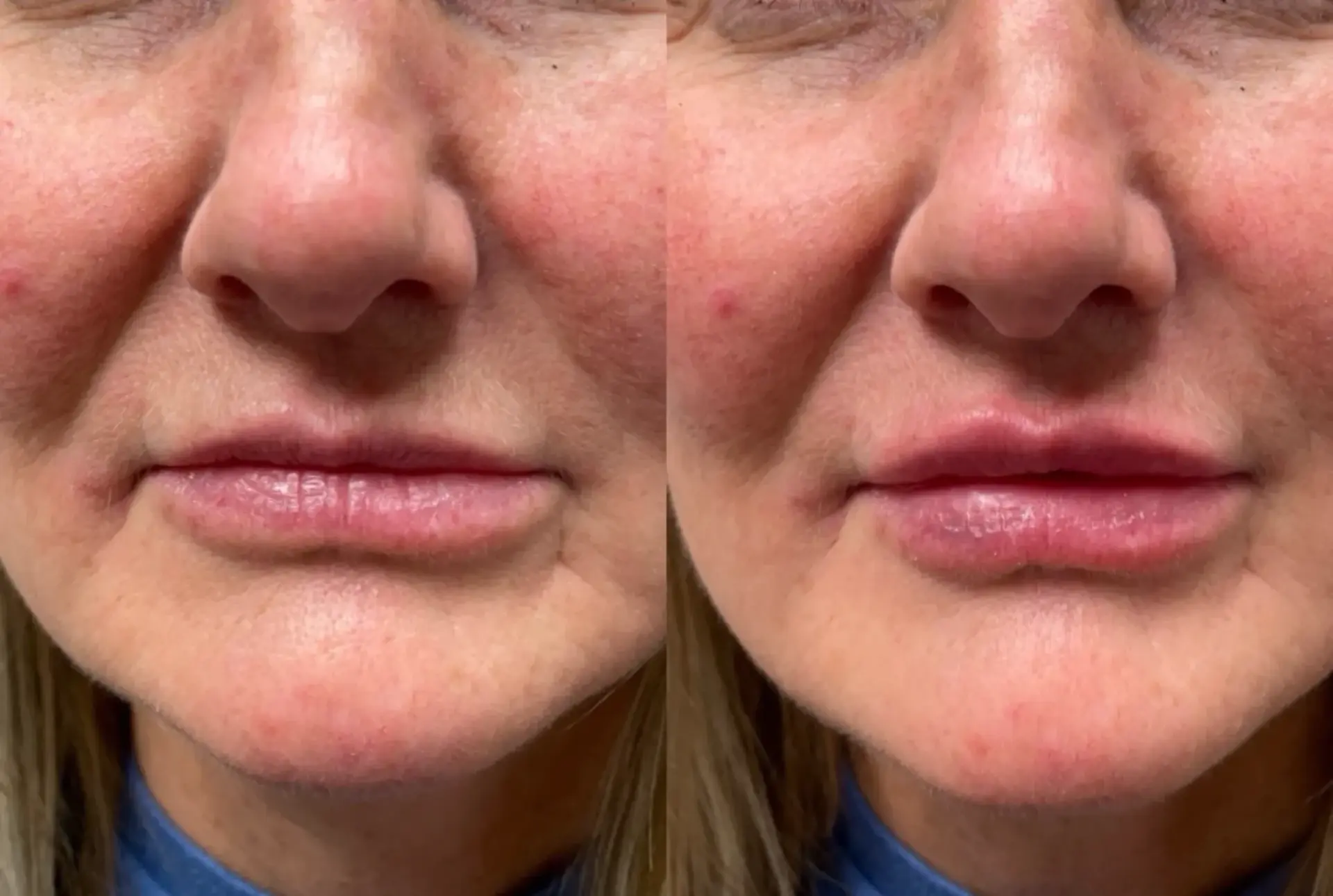Park City Medesthetix lip filler result — Park City, UT