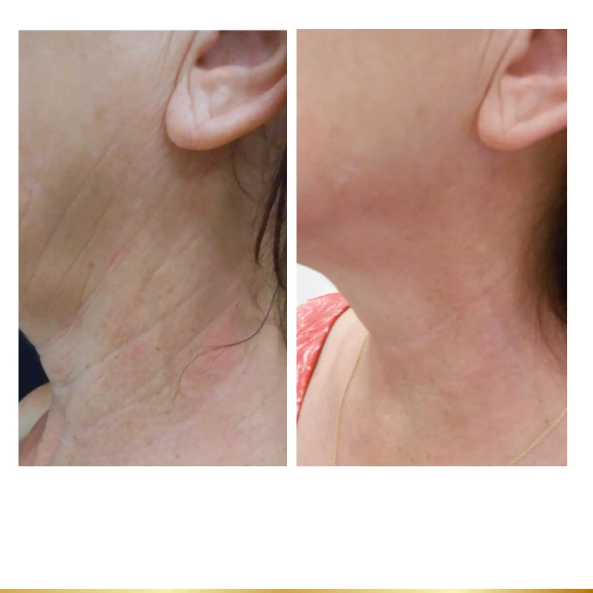 Park City Medesthetix skin tightening result — Park City, UT