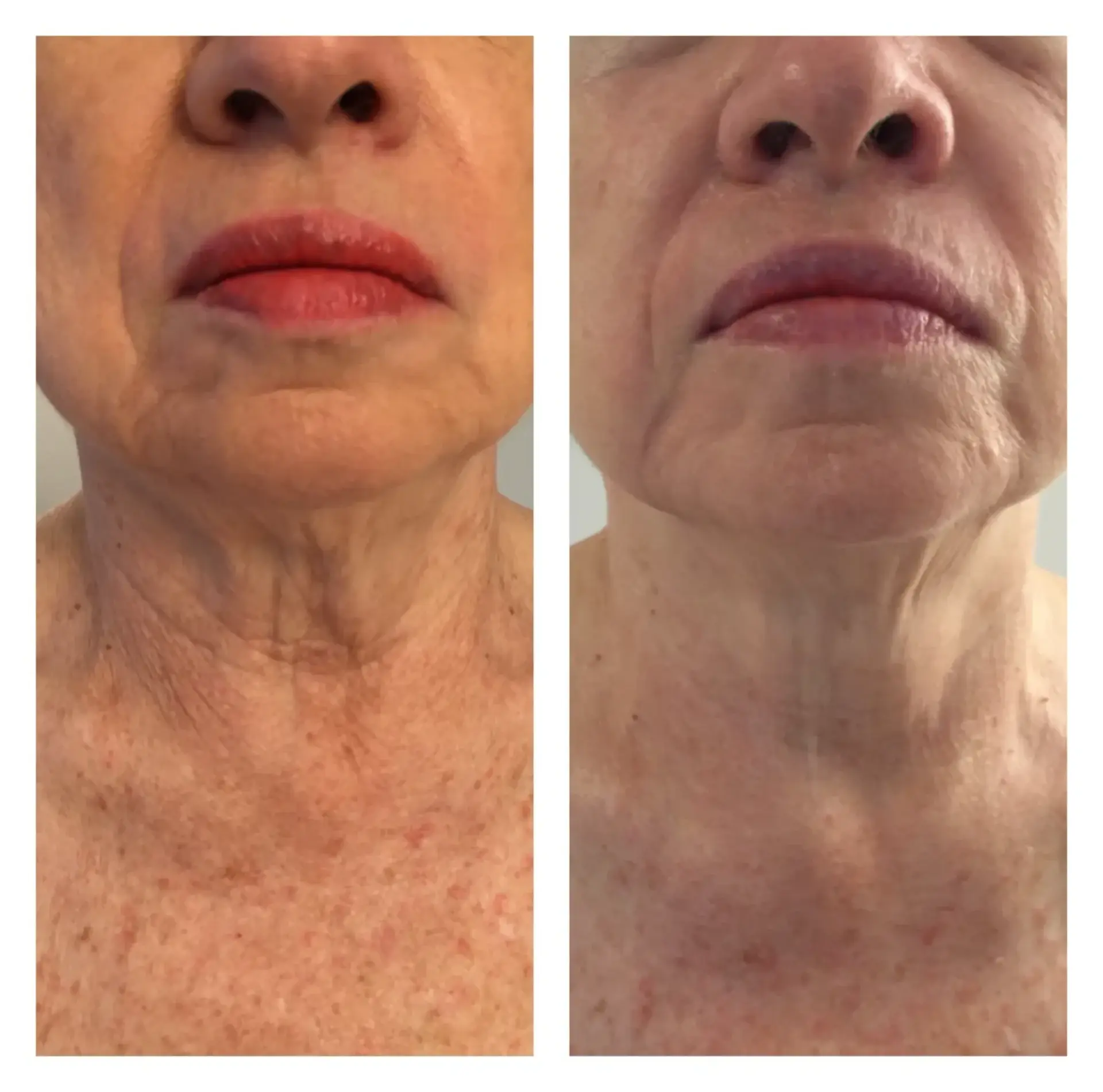 Park City Medesthetix skin tightening result — Park City, UT
