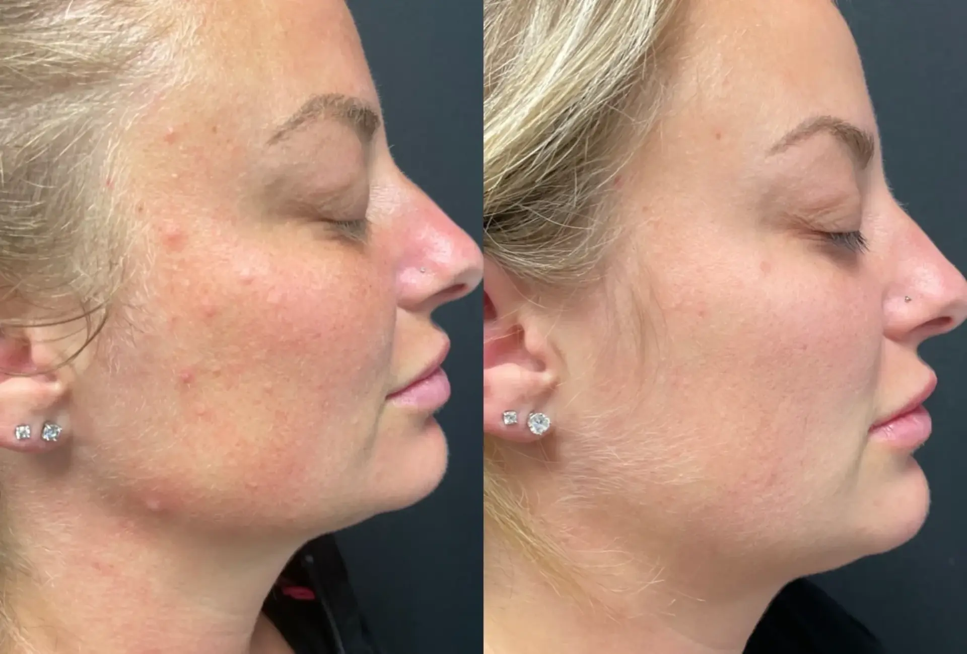 Park City Medesthetix acne treatment result — Park City, UT