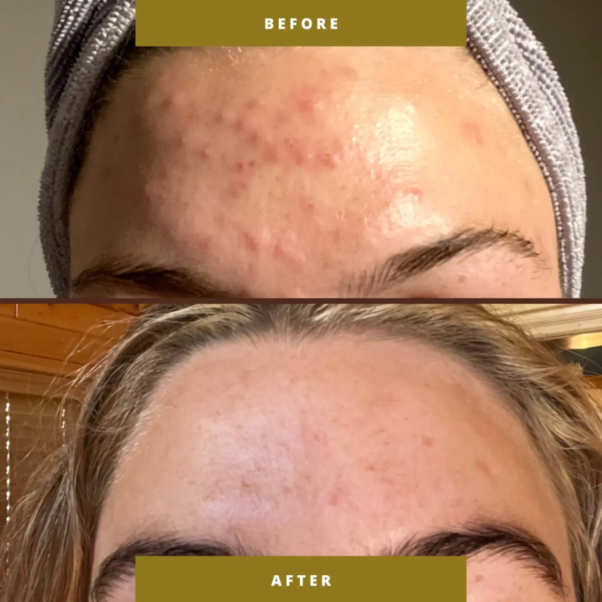 Park City Medesthetix acne treatment result — Park City, UT