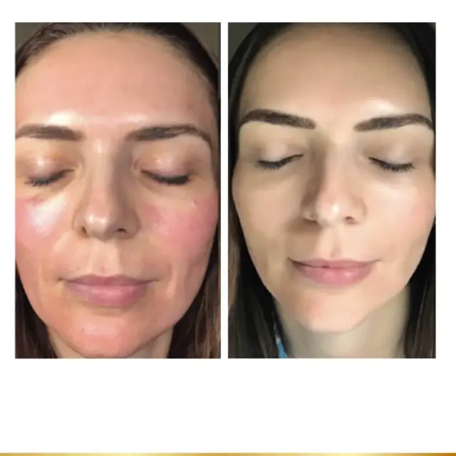 Chemical Peel result at Park City Medesthetix in Park City, UT