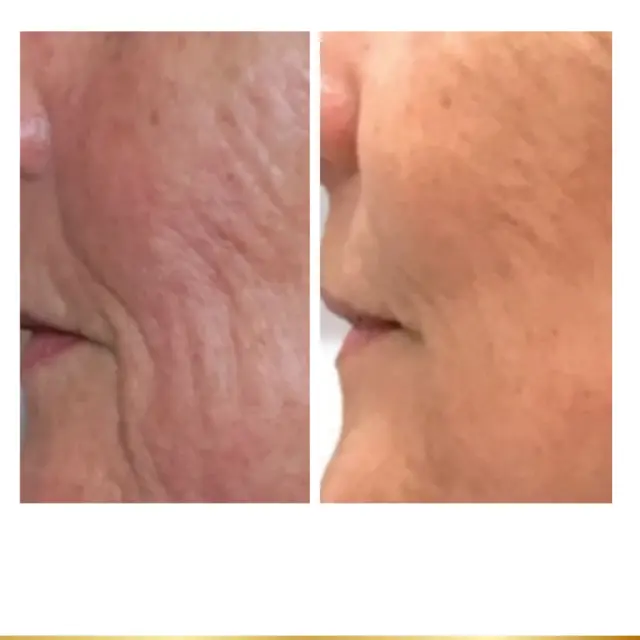 Microneedling result at Park City Medesthetix in Park City, UT