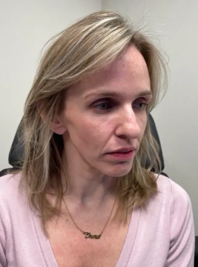 Dermal Fillers before at Park City Medesthetix in Park City, UT