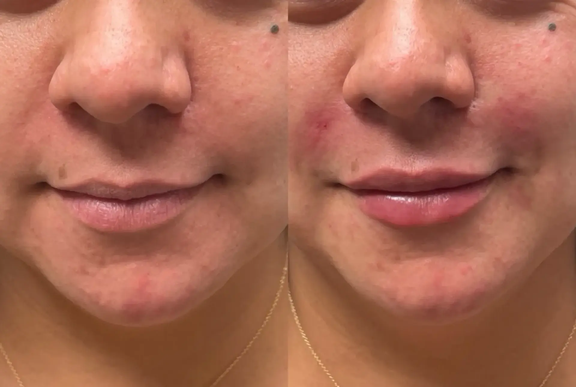 Park City Medesthetix lip filler result — Park City, UT