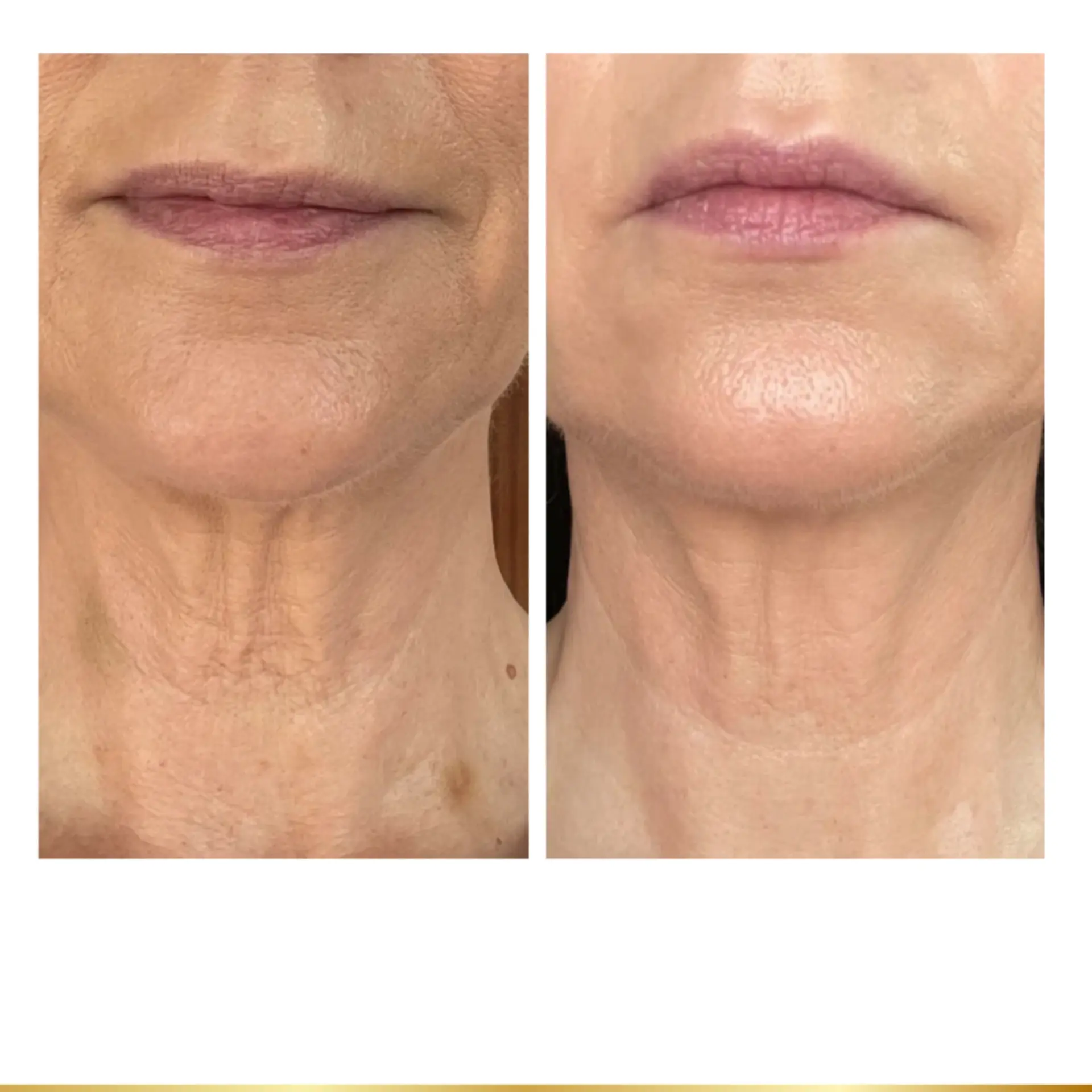 Park City Medesthetix skin tightening result — Park City, UT