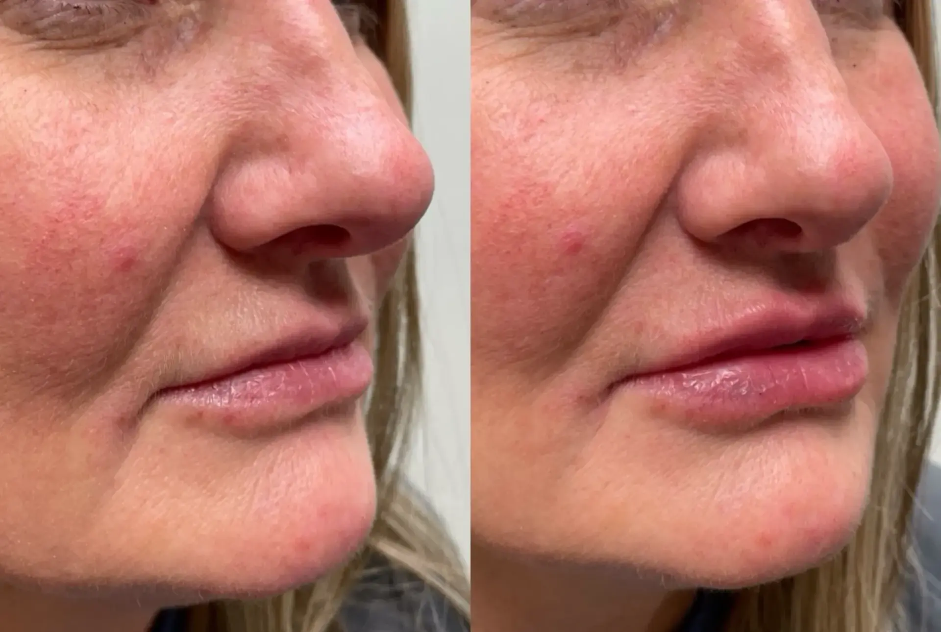 Park City Medesthetix lip filler result — Park City, UT