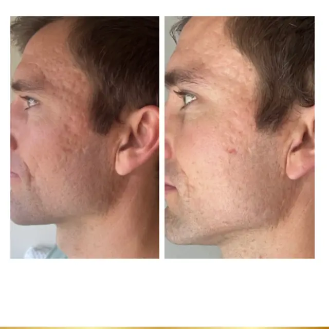 Microneedling result at Park City Medesthetix in Park City, UT