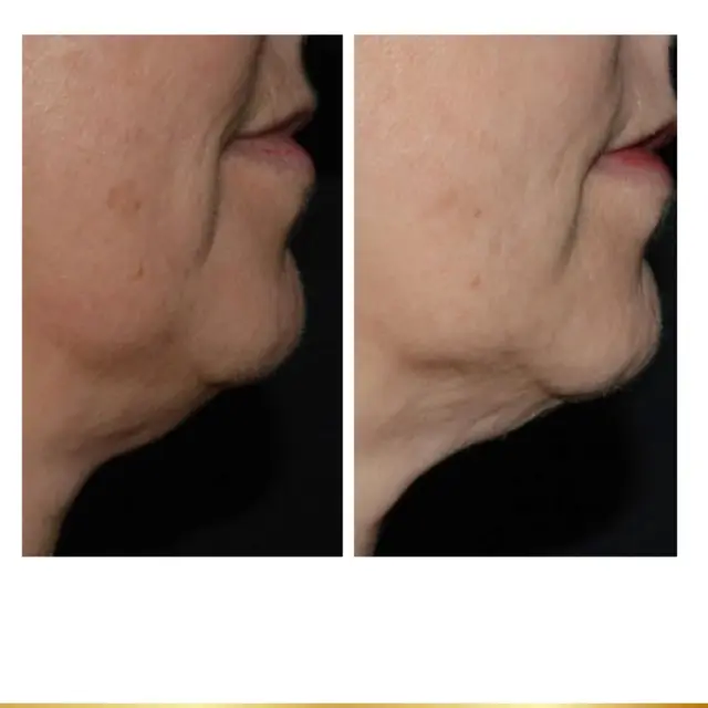 Microneedling result at Park City Medesthetix in Park City, UT
