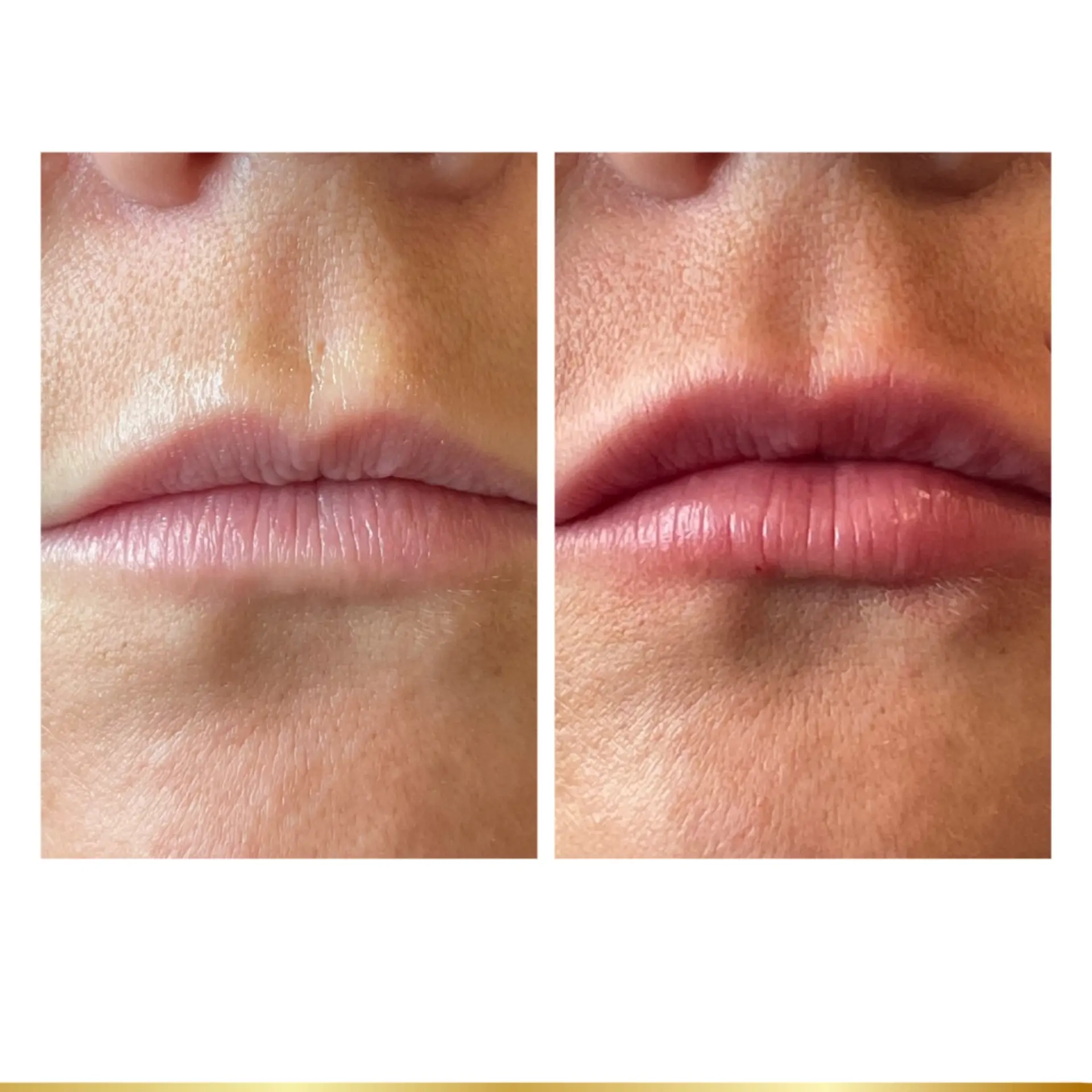 Park City Medesthetix lip filler result — Park City, UT