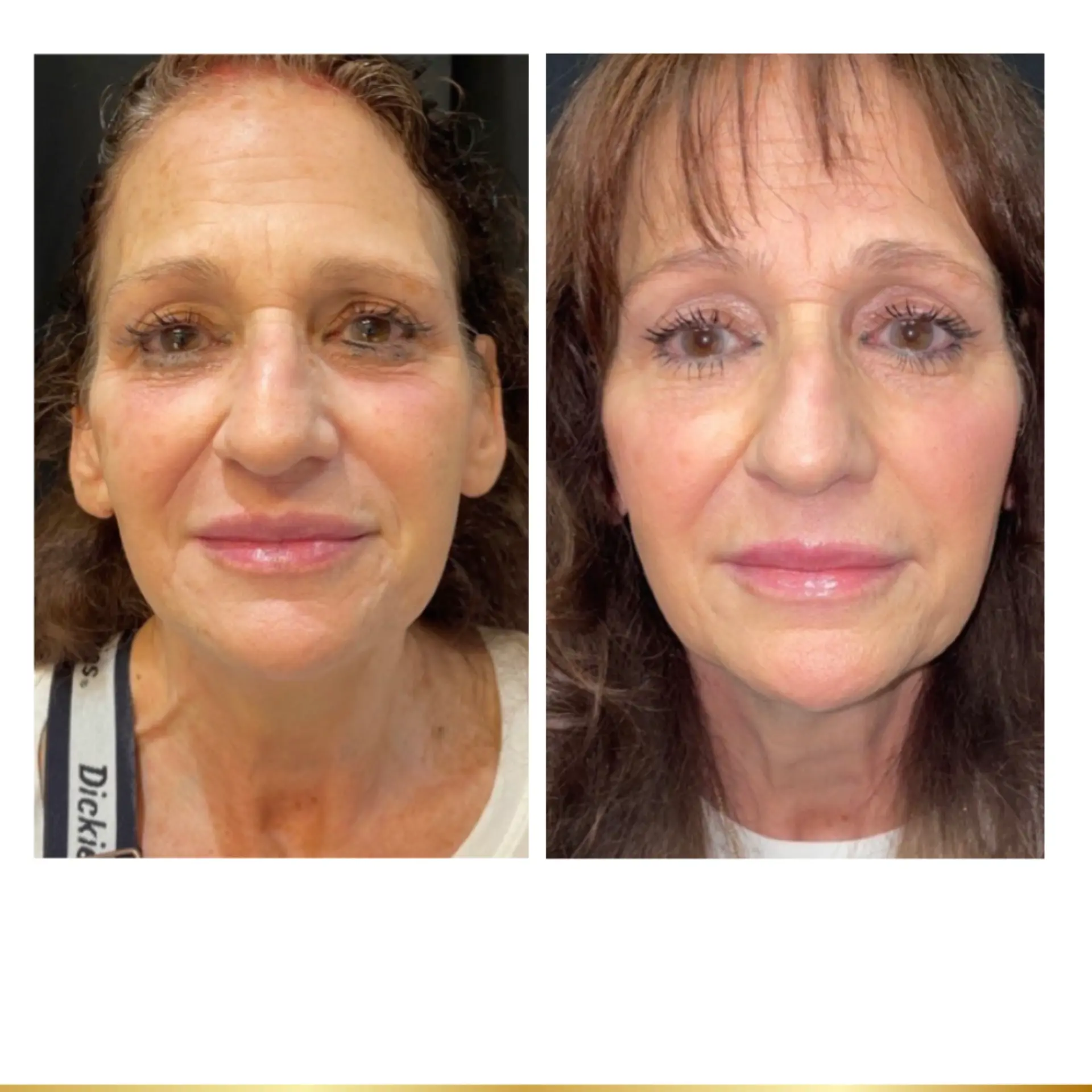 Park City Medesthetix cheek filler result — Park City, UT