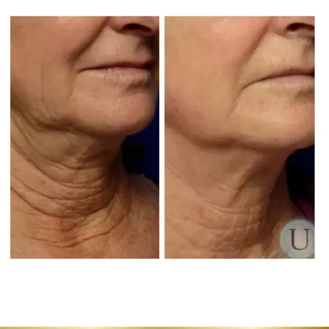 Neck Lift result at Park City Medesthetix in Park City, UT