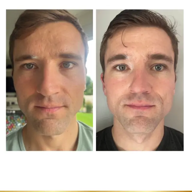 Microneedling result at Park City Medesthetix in Park City, UT