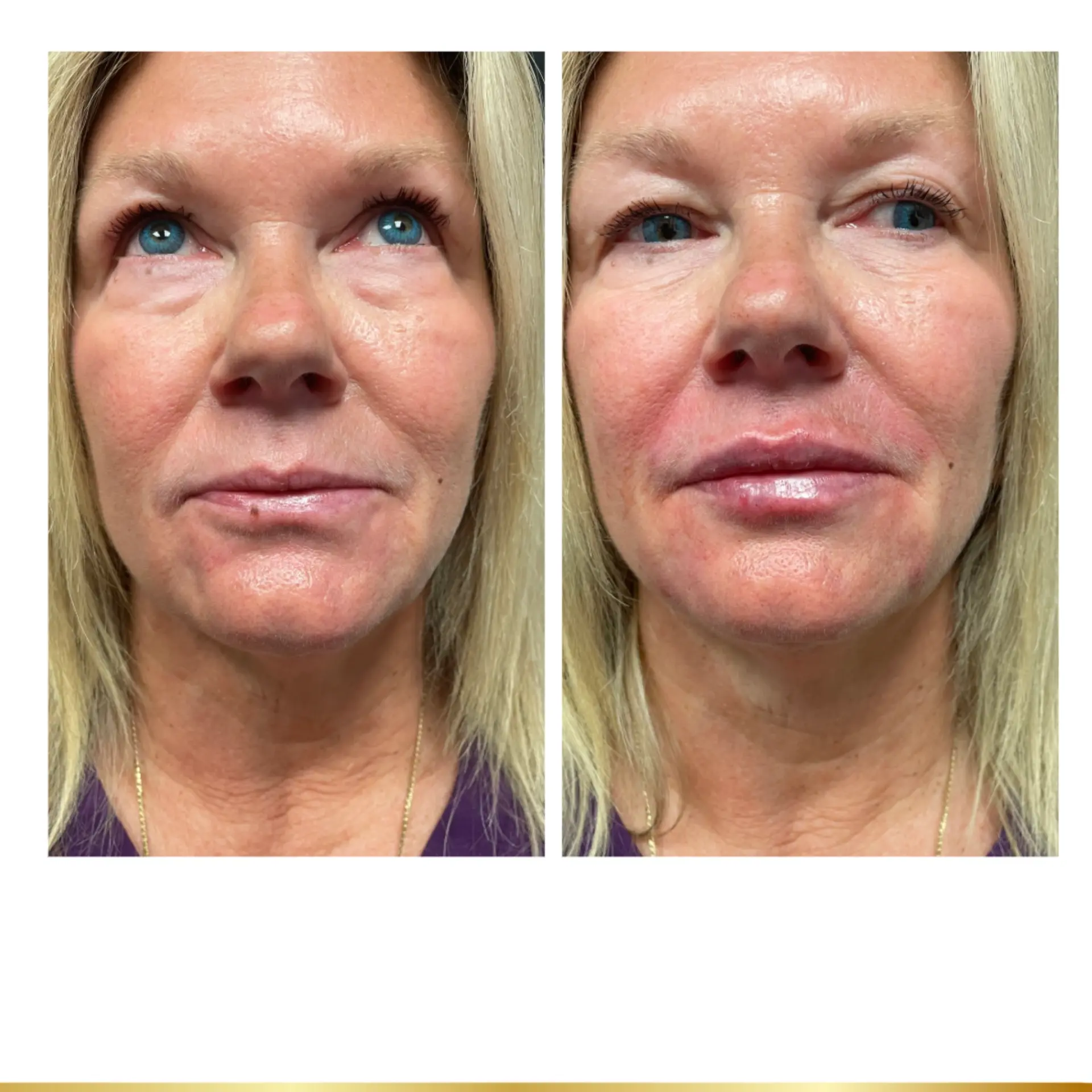 Park City Medesthetix lip filler result — Park City, UT