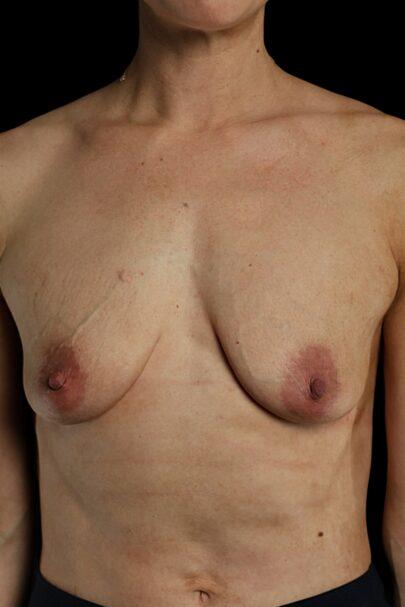 Breast Lift before at Garlick Plastic Surgery in Salt Lake Valley, UT