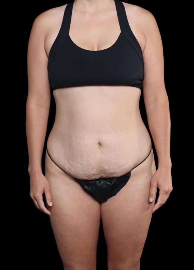 Liposuction before at Garlick Plastic Surgery in Draper, UT