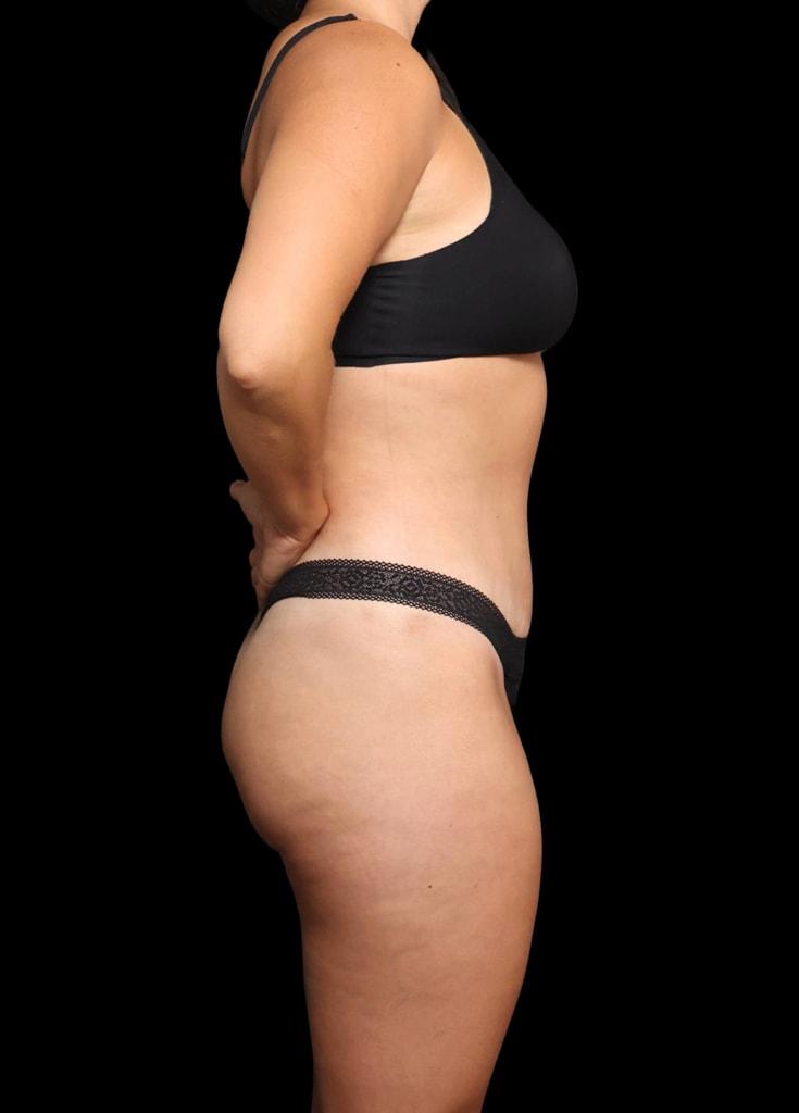 Garlick Plastic Surgery liposuction after — Salt Lake Valley, UT