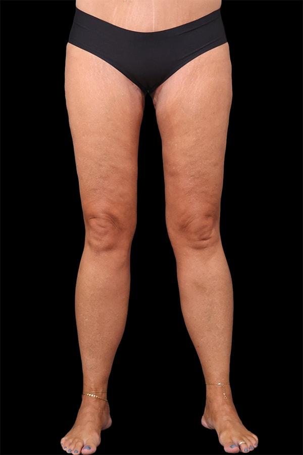 Garlick Plastic Surgery thigh lift after — Draper, UT