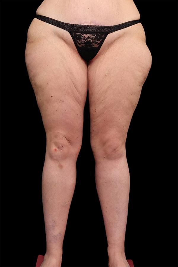 Thigh Lift before at Garlick Plastic Surgery in Draper, UT
