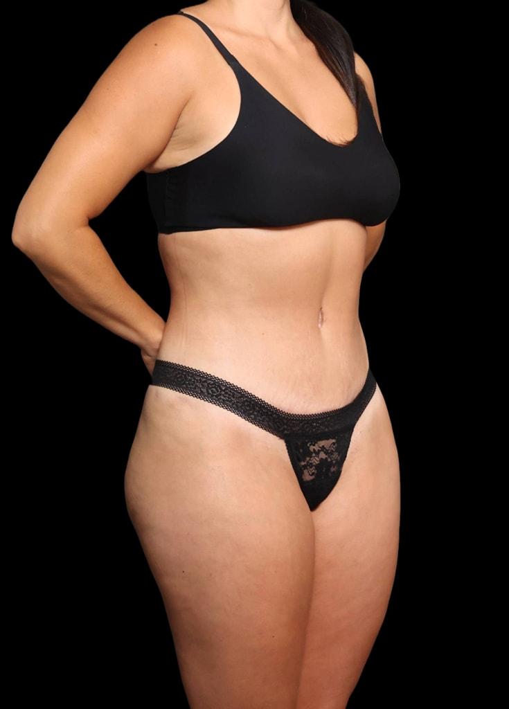 Garlick Plastic Surgery liposuction after — Salt Lake Valley, UT