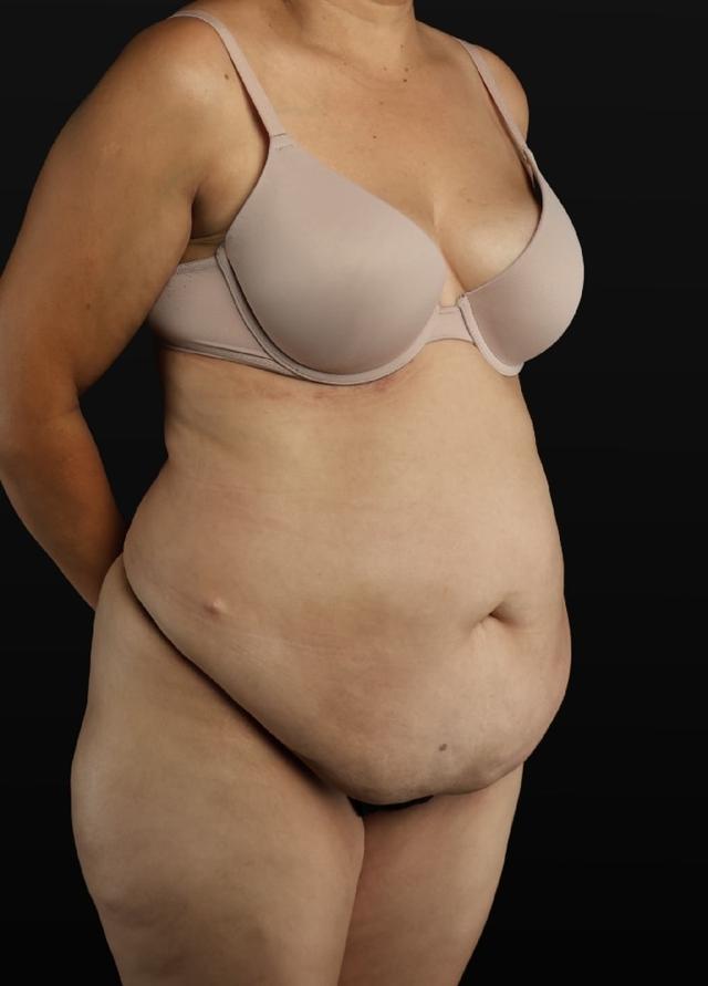 Mini Tummy Tuck before at Garlick Plastic Surgery in Draper, UT