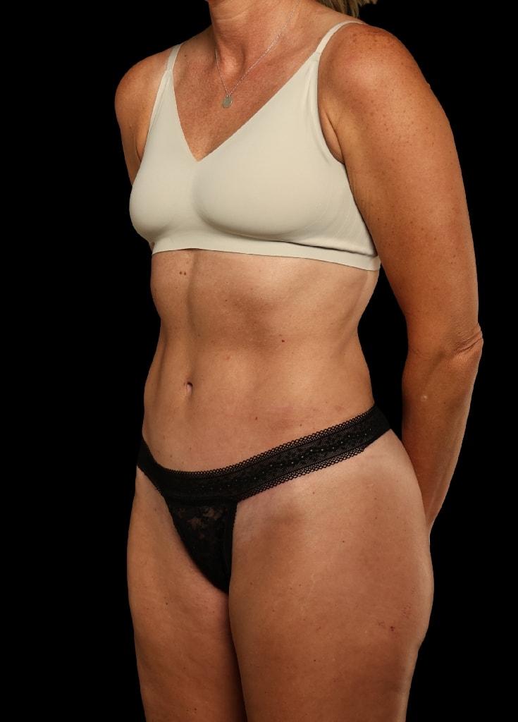 Garlick Plastic Surgery tummy tuck after — Draper, UT