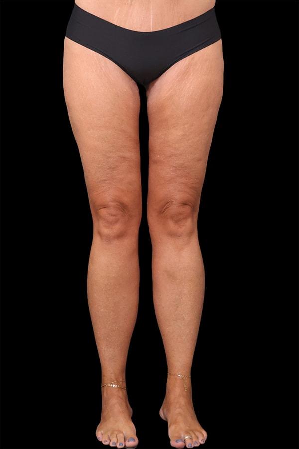 Garlick Plastic Surgery thigh lift after — Draper, UT