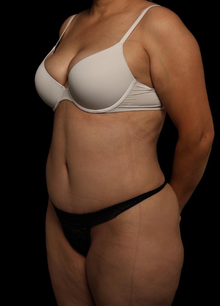 Garlick Plastic Surgery tummy tuck after — Draper, UT