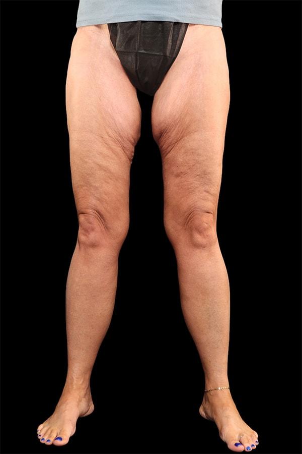 Thigh Lift before at Garlick Plastic Surgery in Draper, UT