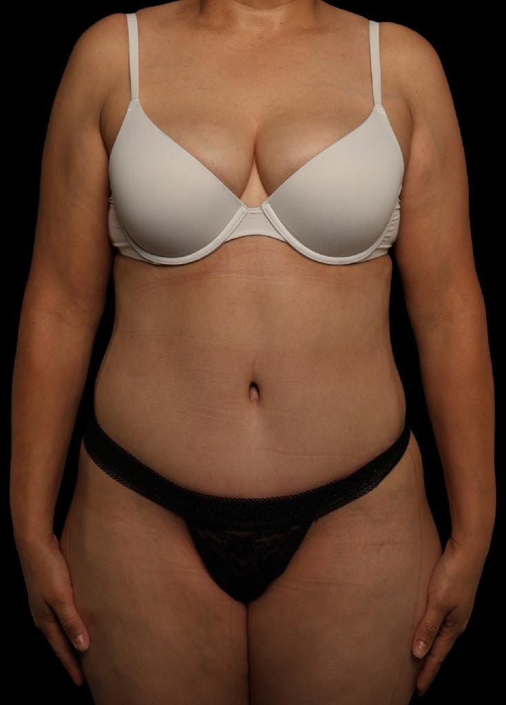 Garlick Plastic Surgery tummy tuck after — Draper, UT