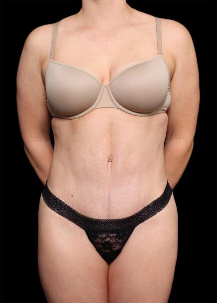 Tummy Tuck after at Garlick Plastic Surgery in Salt Lake Valley, UT