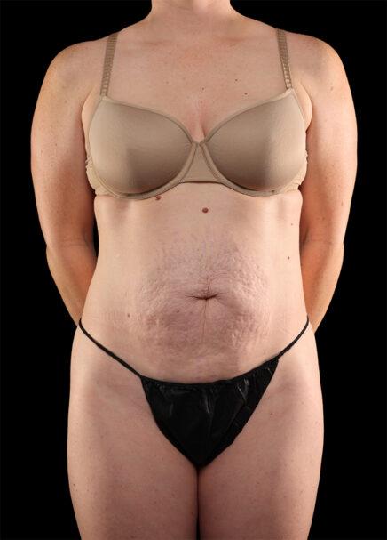Tummy Tuck before at Garlick Plastic Surgery in Salt Lake Valley, UT