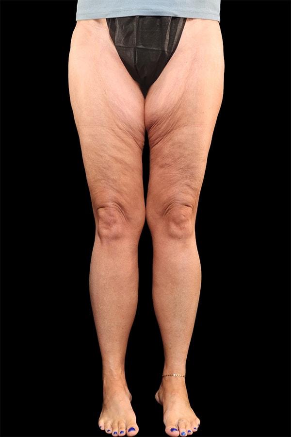 Thigh Lift before at Garlick Plastic Surgery in Draper, UT