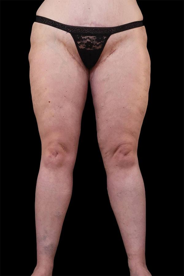 Thigh Lift after at Garlick Plastic Surgery in Draper, UT