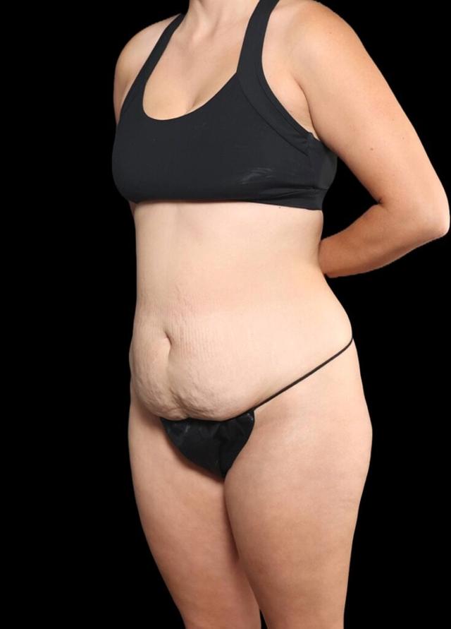 Liposuction before at Garlick Plastic Surgery in Draper, UT