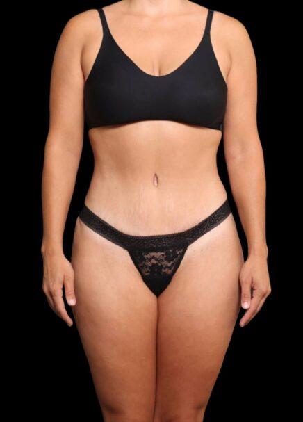 Garlick Plastic Surgery tummy tuck after — Salt Lake Valley, UT