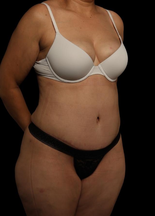 Mini Tummy Tuck after at Garlick Plastic Surgery in Draper, UT