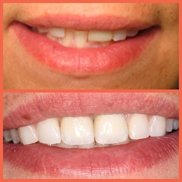 Legacy Dental smile makeover result — Salt Lake City, UT