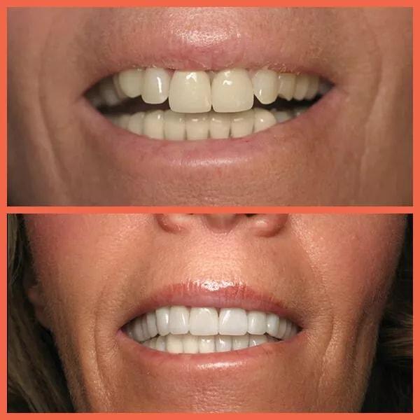 Legacy Dental dental crowns result — Salt Lake City, UT