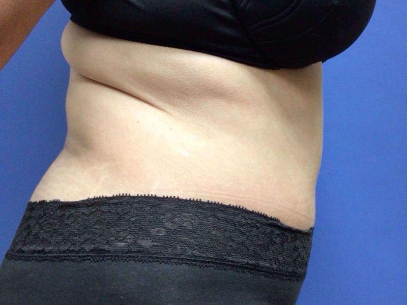Vandegrift Plastic Surgery tummy tuck after — Huntington, NY