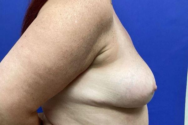 Vandegrift Plastic Surgery breast reduction after — Huntington, NY