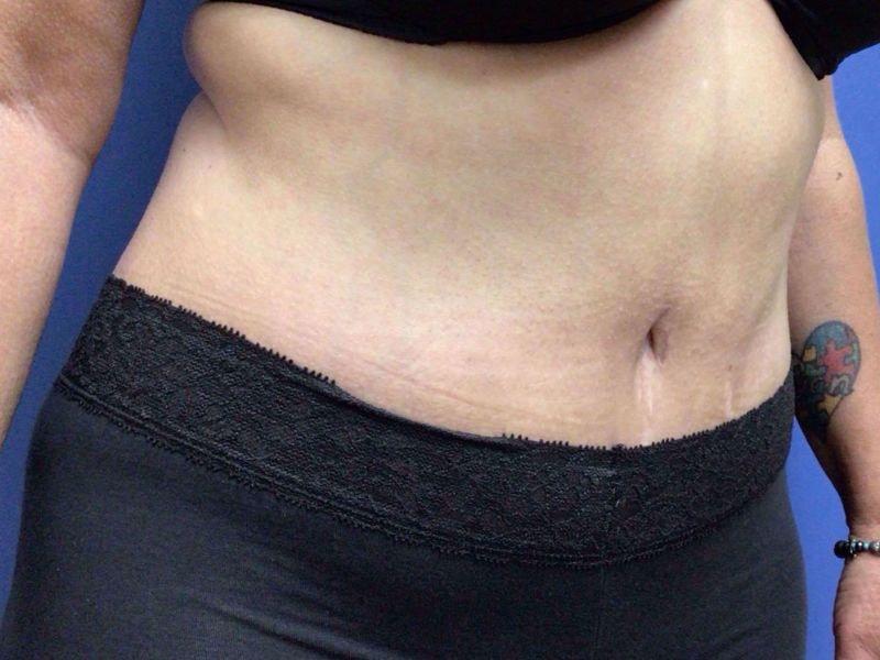 Vandegrift Plastic Surgery tummy tuck after — Huntington, NY