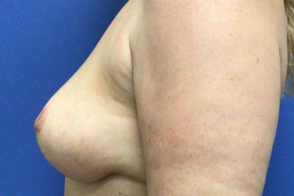 Vandegrift Plastic Surgery breast reduction after — Huntington, NY